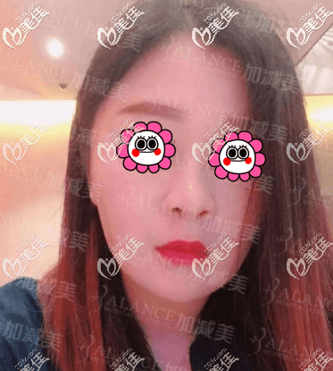 了解了V美減齡怎么做和保持時(shí)間我就做了手術(shù) 了解了V美減齡怎么做和保持時(shí)間我就做了手術(shù)