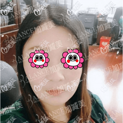 我的V美減齡面部提升術(shù)后一個(gè)月效果圖 我的V美減齡面部提升術(shù)后一個(gè)月效果圖