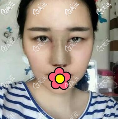 蘭州仁和做鼻子第1天 蘭州仁和做鼻子第1天