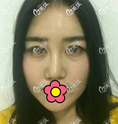 蘭州仁和整形醫(yī)院耳軟骨隆鼻前 蘭州仁和整形醫(yī)院耳軟骨隆鼻前