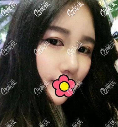 耳軟骨墊鼻尖+硅膠隆鼻一個(gè)月效果圖 耳軟骨墊鼻尖+硅膠隆鼻一個(gè)月效果圖