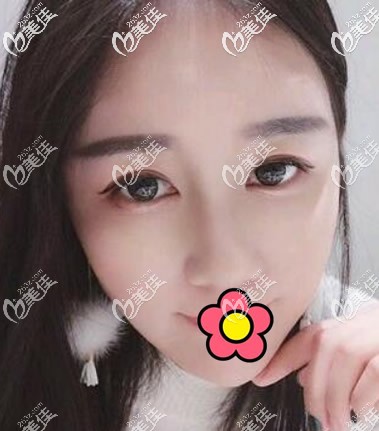 蘭州仁和<!--<i data=20240703-sp></i>-->做耳軟骨隆鼻半個(gè)月 蘭州仁和<!--<i data=20240703-sp></i>-->做耳軟骨隆鼻半個(gè)月