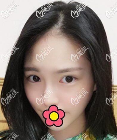 美國755蜂巢皮秒祛斑10天效果 美國755蜂巢皮秒祛斑10天效果