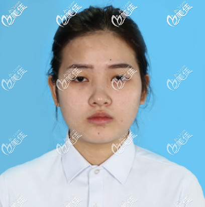 去廣州廣美做雙眼皮隆鼻術(shù)前照片 去廣州廣美做雙眼皮隆鼻術(shù)前照片