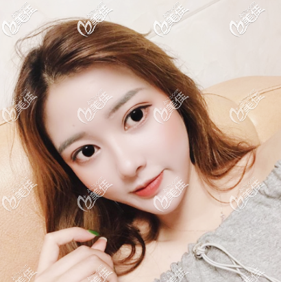 廣州廣美整形徐立志醫(yī)生雙眼皮隆鼻案例 廣州廣美整形徐立志醫(yī)生雙眼皮隆鼻案例