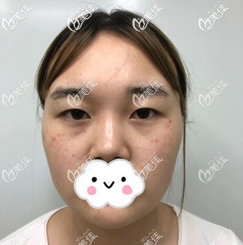 割雙眼皮術(shù)前照 割雙眼皮術(shù)前照