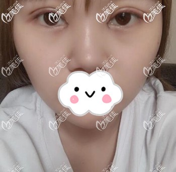 割雙眼皮術(shù)后2天照 割雙眼皮術(shù)后2天照