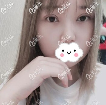 割完雙眼皮一周后拆線 割完雙眼皮一周后拆線