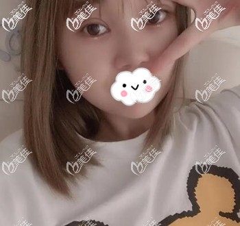 在長沙割雙眼皮術(shù)后20天恢復(fù)效果圖 在長沙割雙眼皮術(shù)后20天恢復(fù)效果圖