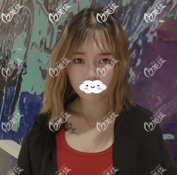 長沙臉博士割雙眼皮術(shù)后60天真人案例恢復(fù)效果圖 長沙臉博士割雙眼皮術(shù)后60天真人案例恢復(fù)效果圖