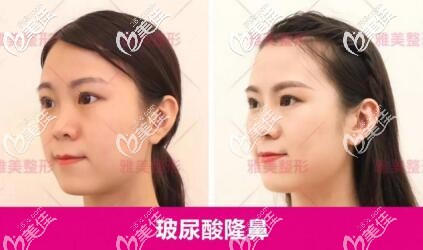 玻尿酸隆鼻真人前后對比效果圖