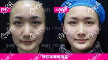 玻尿酸面部填充真人前后對比照