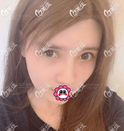 花9萬余在北京沃爾做鼻修復(fù)后才領(lǐng)會(huì)劉彥軍做鼻子這么貴是有原因的