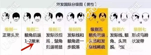 額角脫發(fā)等級分布圖 額角脫發(fā)等級分布圖