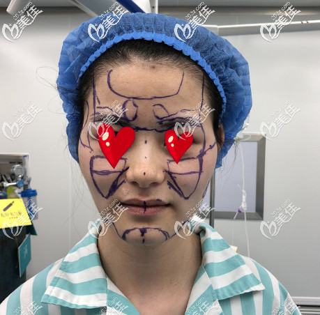 青島華顏美做面部自體脂肪填充手術前的照片 青島華顏美做面部自體脂肪填充手術前的照片