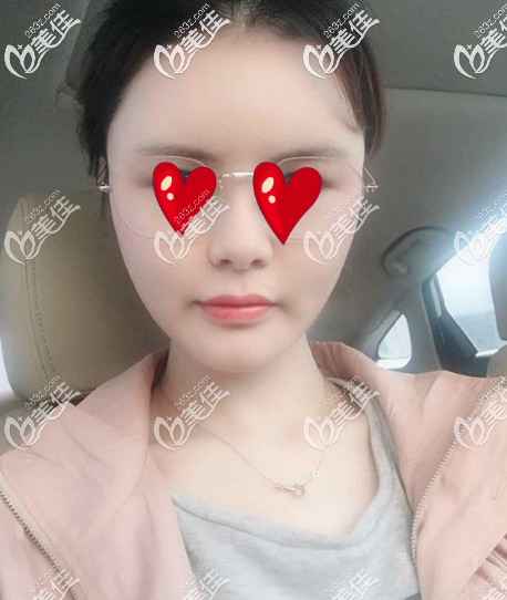 青島華顏美做面部自體脂肪填充手術第三天的樣子 青島華顏美做面部自體脂肪填充手術第三天的樣子