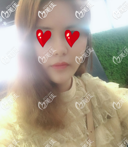 青島華顏美做面部自體脂肪填充手術第四周的樣子 青島華顏美做面部自體脂肪填充手術第四周的樣子