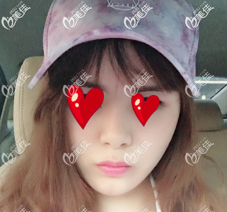 我有資格回答“青島哪家整形醫(yī)院做面部脂肪填充好”，畢竟我已經做了兩個月了