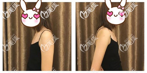 曼托假體隆胸前 曼托假體隆胸前