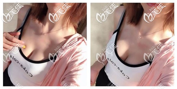 假體豐胸三個月沒有出現(xiàn)硬結(jié)及包膜攣縮 假體豐胸三個月沒有出現(xiàn)硬結(jié)及包膜攣縮