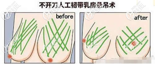 不開刀人工韌帶提胸手術(shù)矯正乳房下垂不留疤