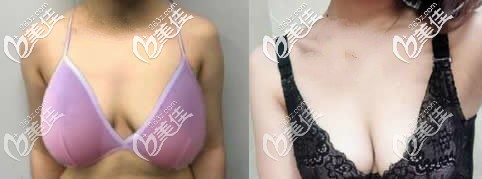 人工韌帶提胸術(shù)后圖片