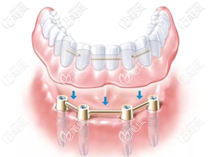 allon4種植牙圖片 allon4種植牙圖片