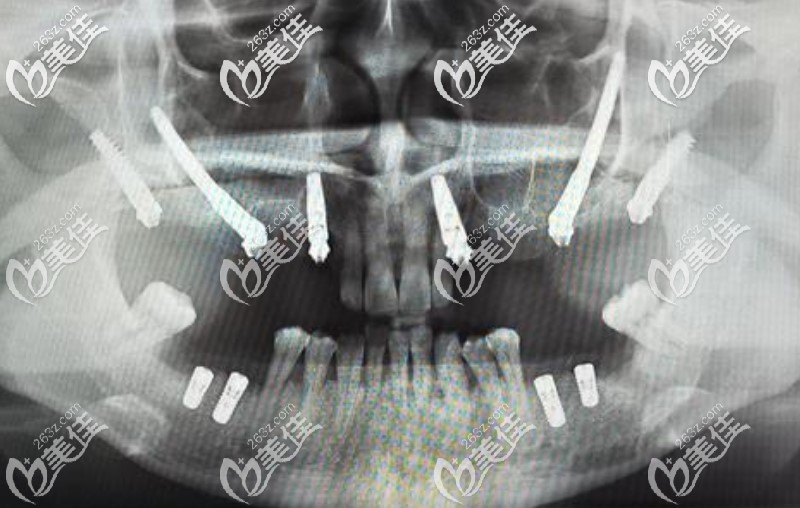 穿顴穿翼種植牙示意圖 穿顴穿翼種植牙示意圖