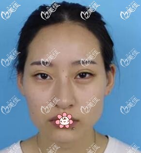 我術(shù)前的樣子 我術(shù)前的樣子