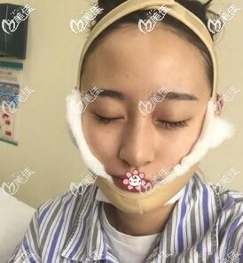 我在咖蒙醫(yī)院做完磨骨一周 我在咖蒙醫(yī)院做完磨骨一周