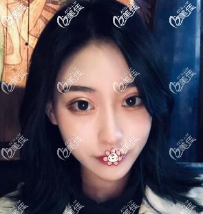 感覺國內(nèi)磨骨好的醫(yī)院價(jià)位高就去了泰國KAMOL咖蒙做了下頜角+顴骨磨骨