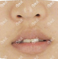 蘭州韓美整形醫(yī)院做厚唇變薄術(shù)前 蘭州韓美整形醫(yī)院做厚唇變薄術(shù)前