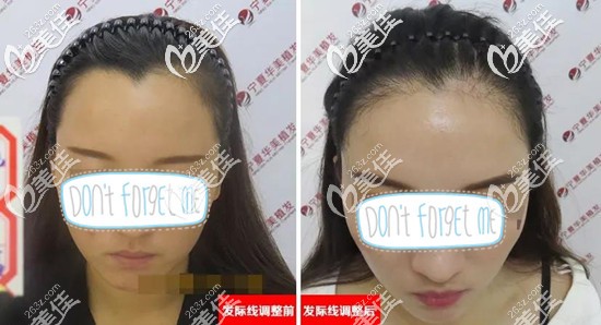 爆寧夏銀川華美發(fā)際線種植前后效果對比照!猜猜我找植發(fā)花了多少錢?