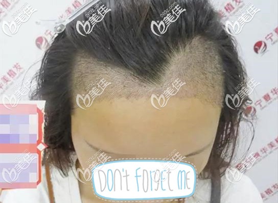 發(fā)際線種植7天術(shù)后照片 發(fā)際線種植7天術(shù)后照片