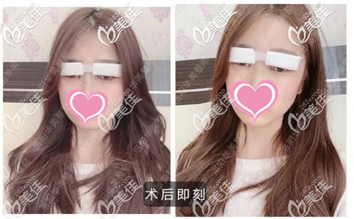 雙眼皮手術后即刻效果