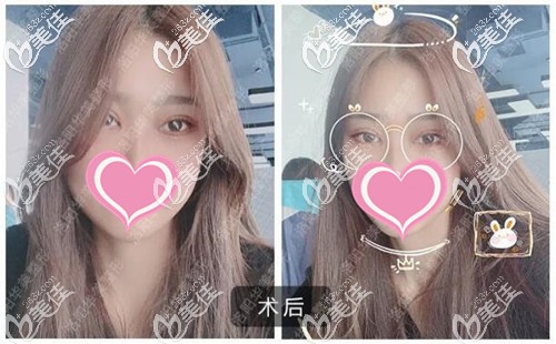 雙眼皮手術恢復7天的效果圖