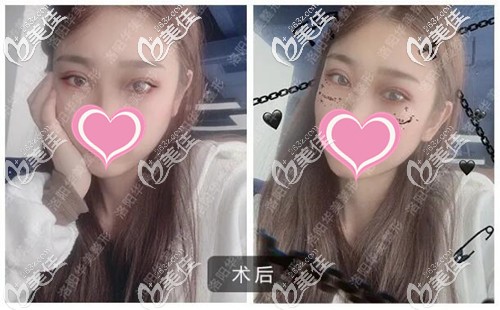 雙眼皮手術恢復一個月的效果