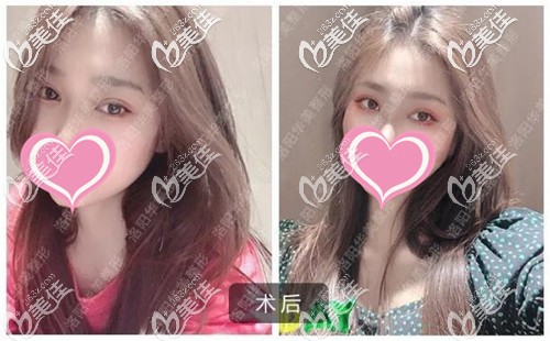 雙眼皮手術恢復三個月沒有疤痕增生