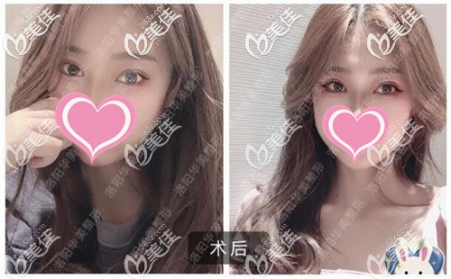 我猜在找洛陽(yáng)哪個(gè)醫(yī)院割雙眼皮好的你急需這份洛陽(yáng)華美整形做的全切雙眼皮案例圖