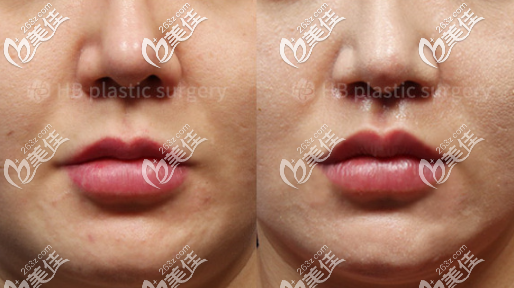 韓國(guó)吳枓映院長(zhǎng)人中縮短和嘴角上揚(yáng)對(duì)比圖