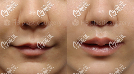 韓國(guó)吳枓映院長(zhǎng)內(nèi)人中縮短+外人中縮短+嘴角上揚(yáng)實(shí)例