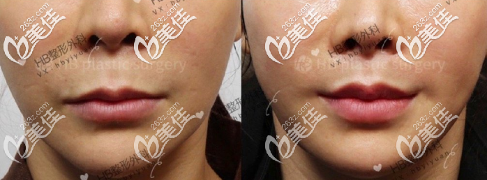 吳枓映院長(zhǎng)人中縮短術(shù)對(duì)比圖