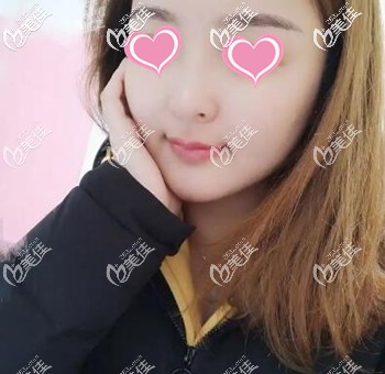 講述2個(gè)月前我在長(zhǎng)沙做面部吸脂手術(shù)的親身經(jīng)歷及恢復(fù)效果照！