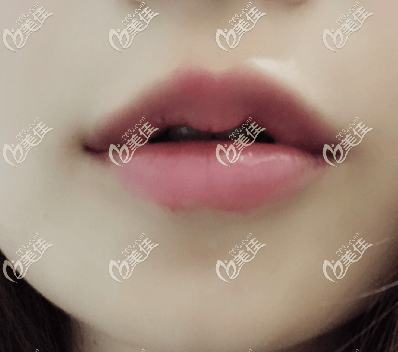 做完伊碗C玻尿酸豐唇頭一日樣子 做完伊碗C玻尿酸豐唇頭一日樣子