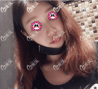 玻尿酸豐嘟嘟唇第二天了 玻尿酸豐嘟嘟唇第二天了