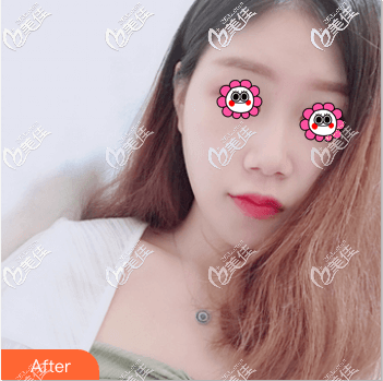 兩月前我做注射豐嘟嘟唇親身經歷告訴你伊婉C玻尿酸豐唇好不好