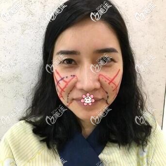 許黎院長(zhǎng)給我手術(shù)當(dāng)天 許黎院長(zhǎng)給我手術(shù)當(dāng)天