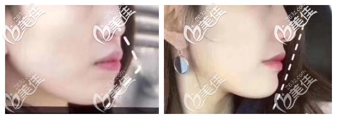 30多歲做深覆合前突矯正后下巴拉出來(lái)被誤認(rèn)為整容，無(wú)奈曬出深覆合矯正前后臉型對(duì)比變化圖