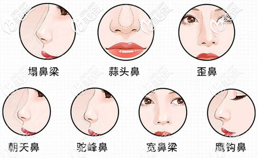茂名華美楊群申擅長(zhǎng)改善各種不好看鼻型 茂名華美楊群申擅長(zhǎng)改善各種不好看鼻型