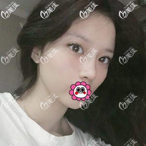 肋軟骨鼻修復(fù)恢復(fù)一個(gè)月<span style= 肋軟骨鼻修復(fù)恢復(fù)一個(gè)月<span style=